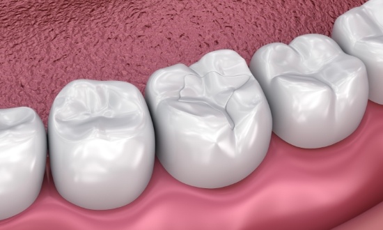 Illustrated row of teeth with white fillings