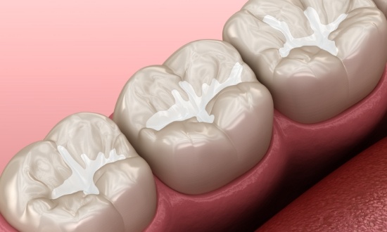 Illustrated row of teeth with dental sealants