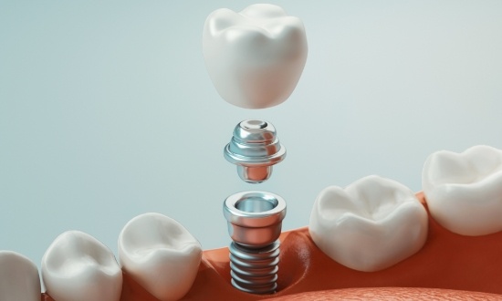 Illustrated dental implant being placed into the lower jaw