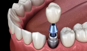 Illustrated dental crown being placed onto a dental implant