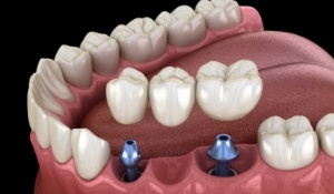 Illustrated dental bridge being placed onto two dental implants