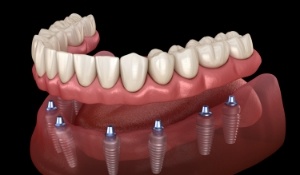 Illustrated full denture being placed onto eight dental implants