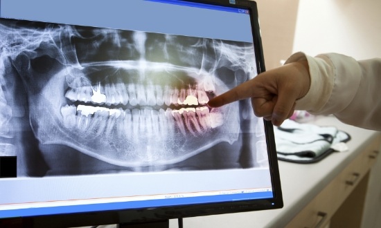 Dentist pointing to a computer screen showing digital x rays of teeth