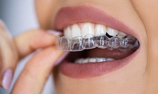 Patient putting on clear aligner