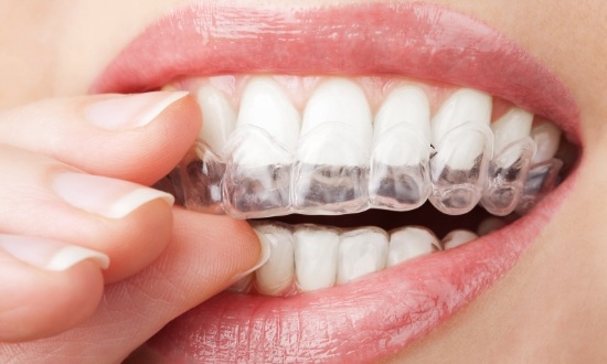 Close up of person putting an Invisalign clear aligner over their teeth
