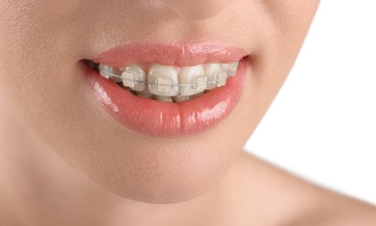 Close up of smile with clear and ceramic braces