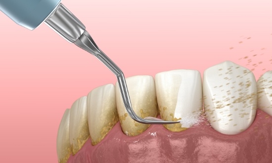 Illustrated dental scaler clearing plaque buildup from teeth