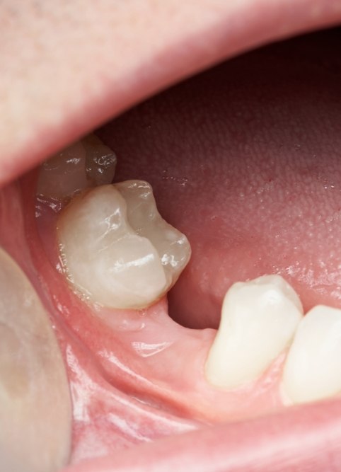 Close up of a mouth with a missing lower tooth