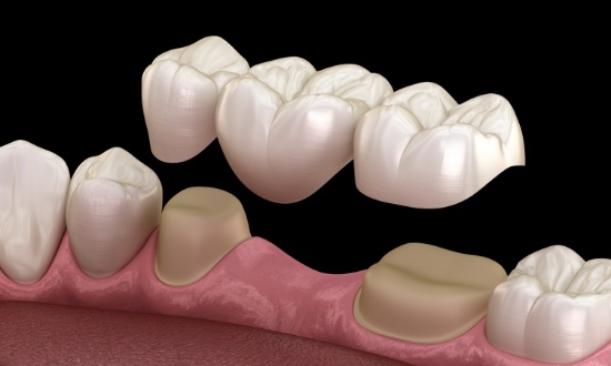 Illustrated dental bridge replacing a missing tooth