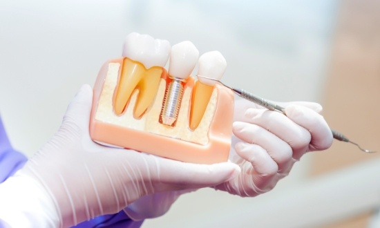 Dentist holding a model of a dental implant