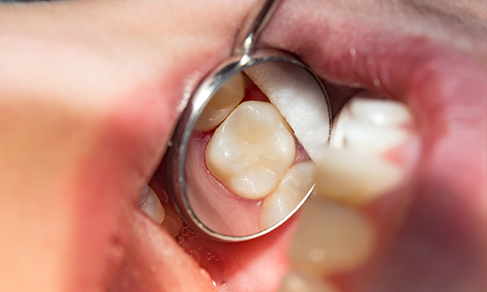 Close up of dental mirror reflecting a tooth