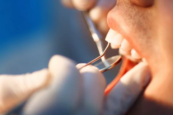Close-up showing dental bonding repairing a chipped tooth