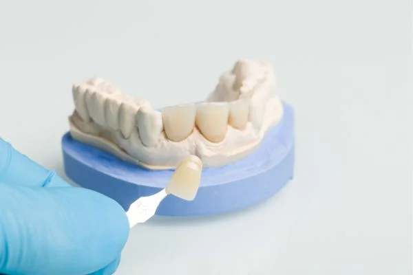 Close-up comparison of teeth before and after porcelain veneers
